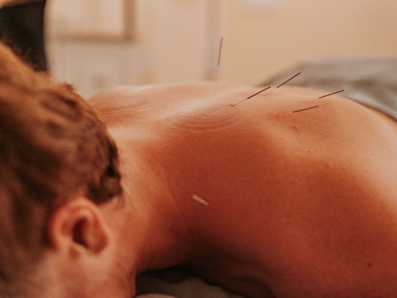 sports acupuncture at insight chiropractic in maitland
